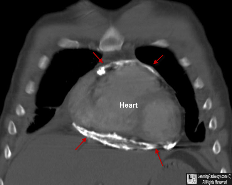 Constrictive Pericarditis